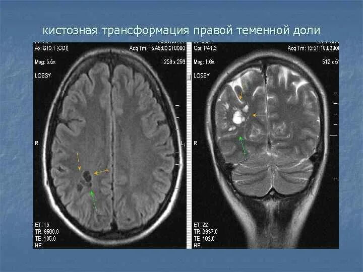 Очаг в правой лобной доли. Глиоз на мрт. Белое вещество левой теменной доли. Белое вещество левой теменной доли. Сосудистые мальформации кт мрт.
