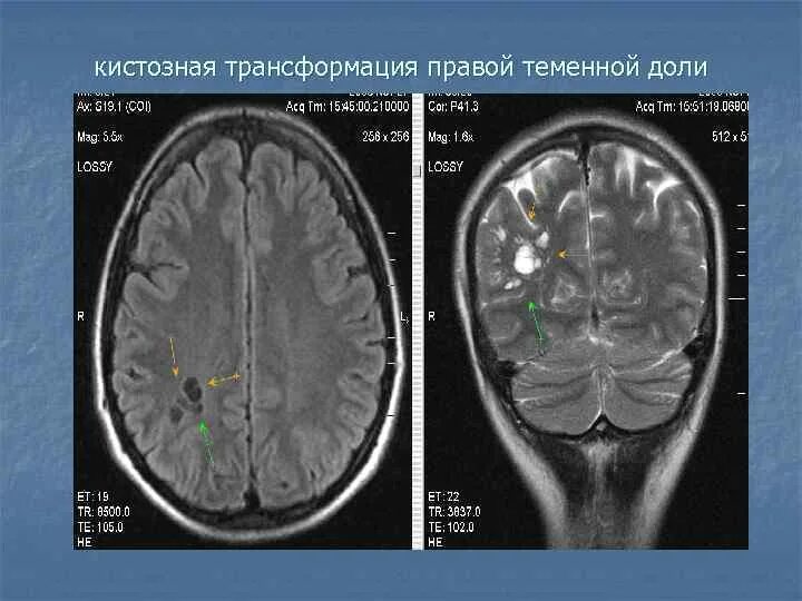 Перивентрикулярная лейкомаляция кт. Кистозная трансформация головного мозга. Аномалии головного мозга. Глиоз головного мозга. Кистозно атрофические изменения головного