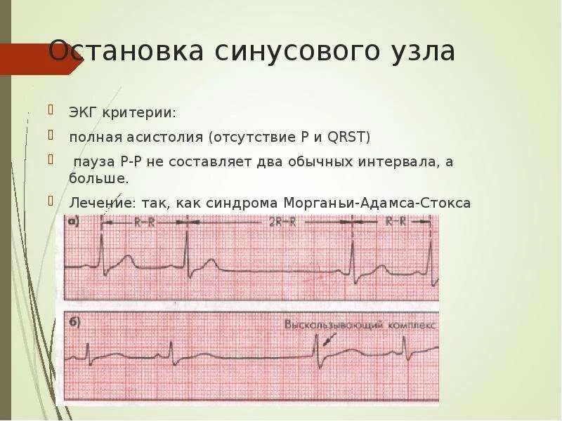 Синусовая пауза на экг. Паузы ритма. Обозначение длительности нот и пауз. Остановка синусового узла на экг. Норма экг у детей 5 лет.