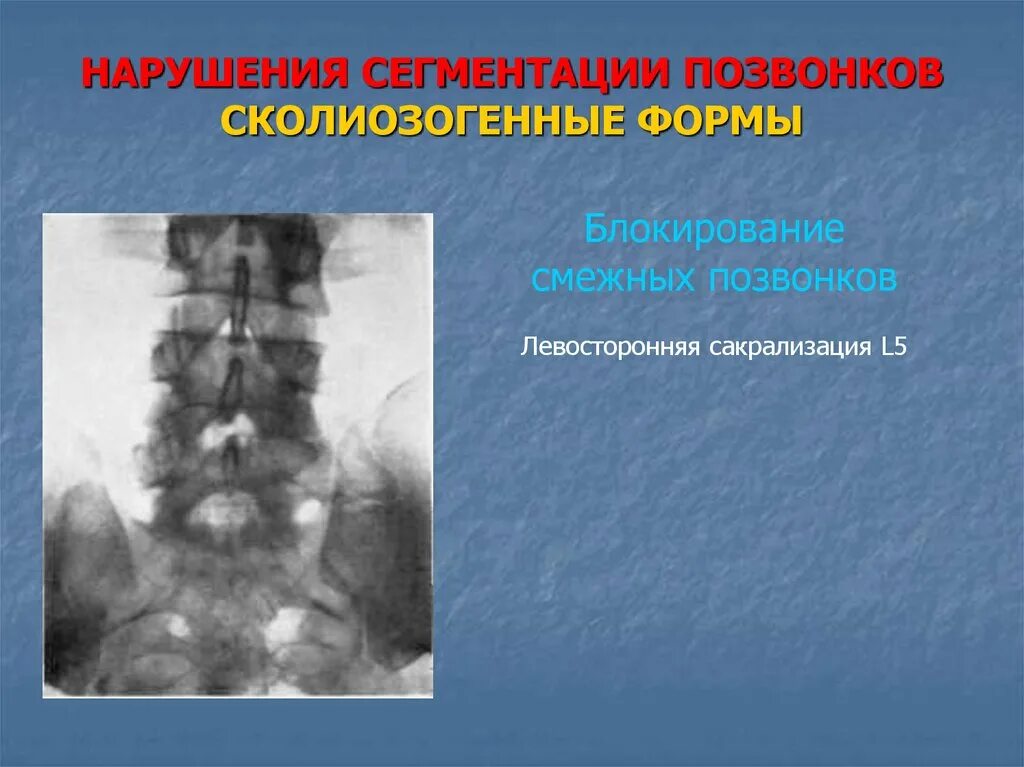 Пороки развития позвоночника. Аномалия сегментации позвонков. Нарушение сегментации позвонков.