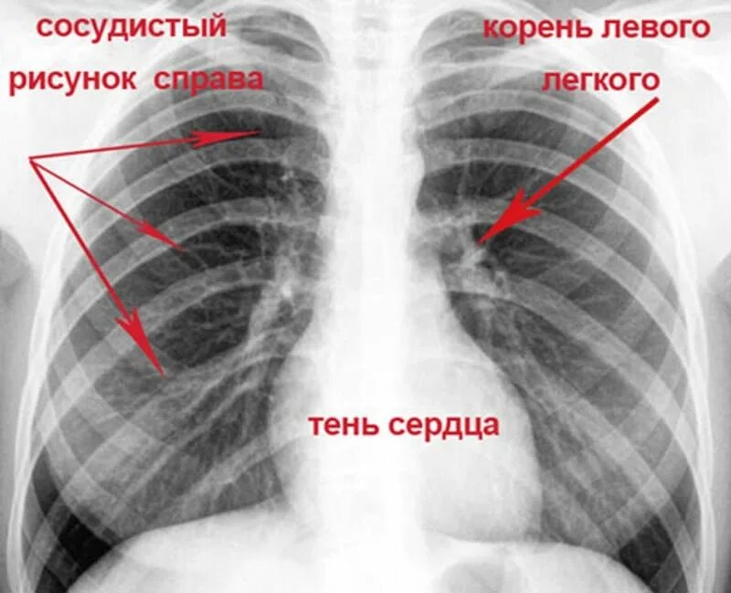Рентген легких. Лёгкие здорового человека флюорография. Снимки легких здорового человека флюорография.