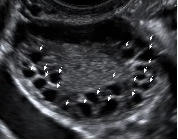 Мультифолликулярные яичники на УЗИ. Поликистоз яичников на УЗИ. Синдром поликистозных яичников УЗИ. Мфя в гинекологии что