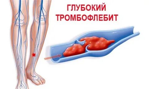 Сколько лечится тромбоз