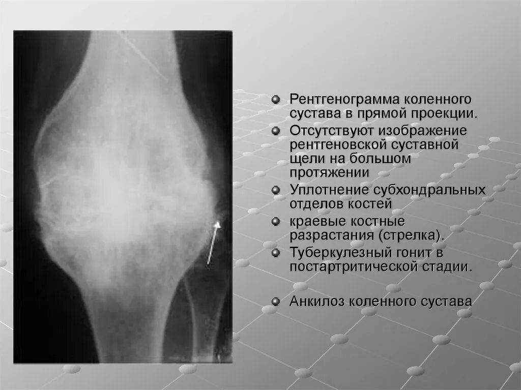 Суставная щель 3 3 мм