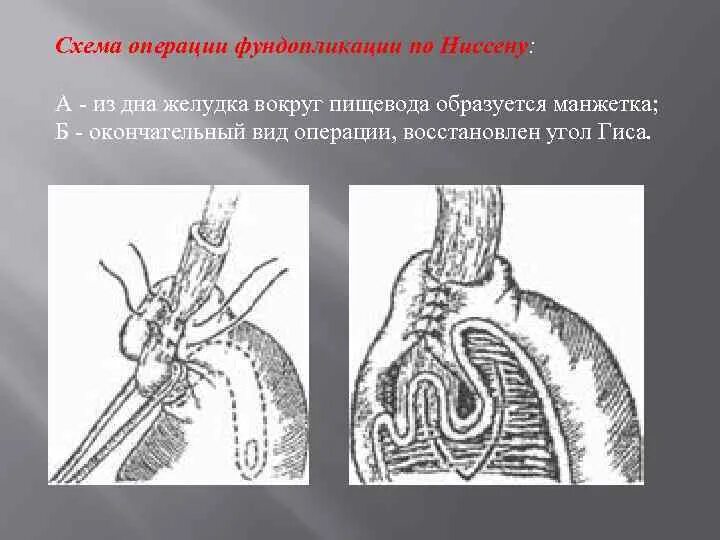 Операции на пищеводе. Операция Ниссена фундопликация. Гастрофундопликация по Ниссену. Операция по Ниссену при ГПОД. Фундопликация желудка.