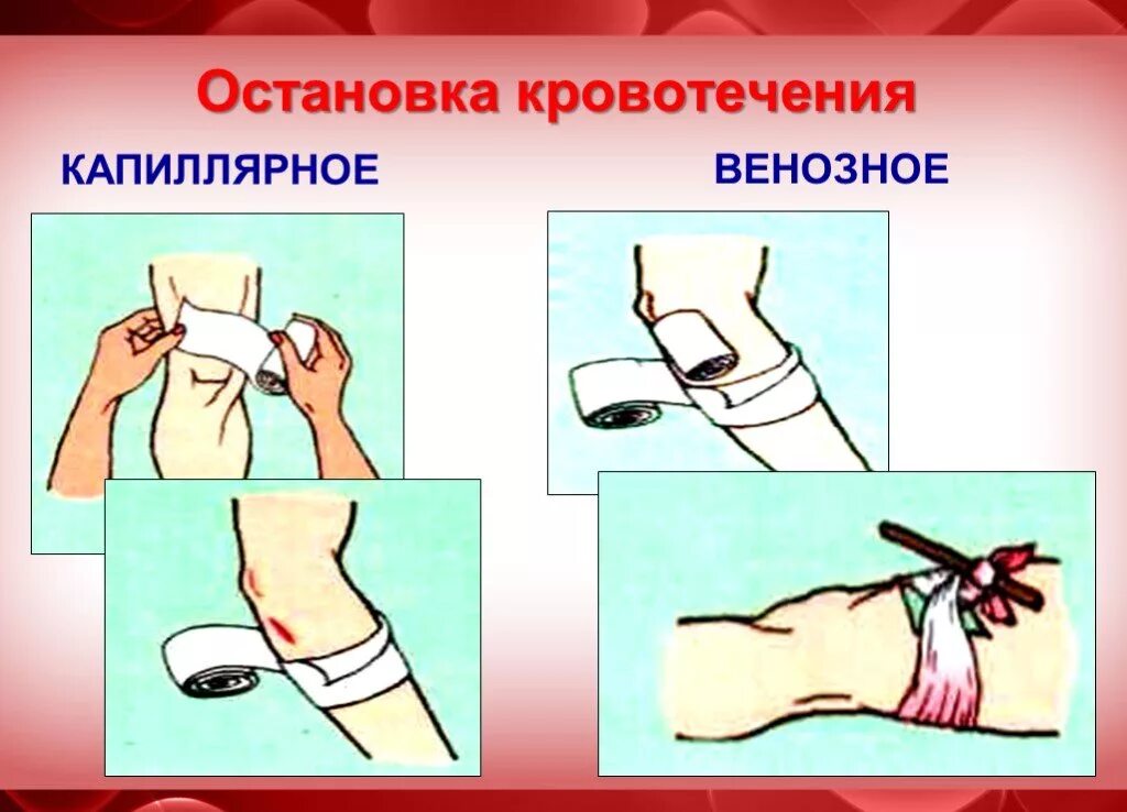 Остановка кровотечения. Остановкавенозгого кровотечения. Остановка венозного кровотечения. Способы остановки артериального и венозного кровотечения. Венозное кровотечение первая помощь алгоритм