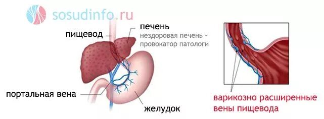 Варикозное расширение вен пищевода ФГДС. Варикозно расширенные вены желудка. Варикозное расширение эзофагеальных вен.. ВРВ пищевода кровотечение.