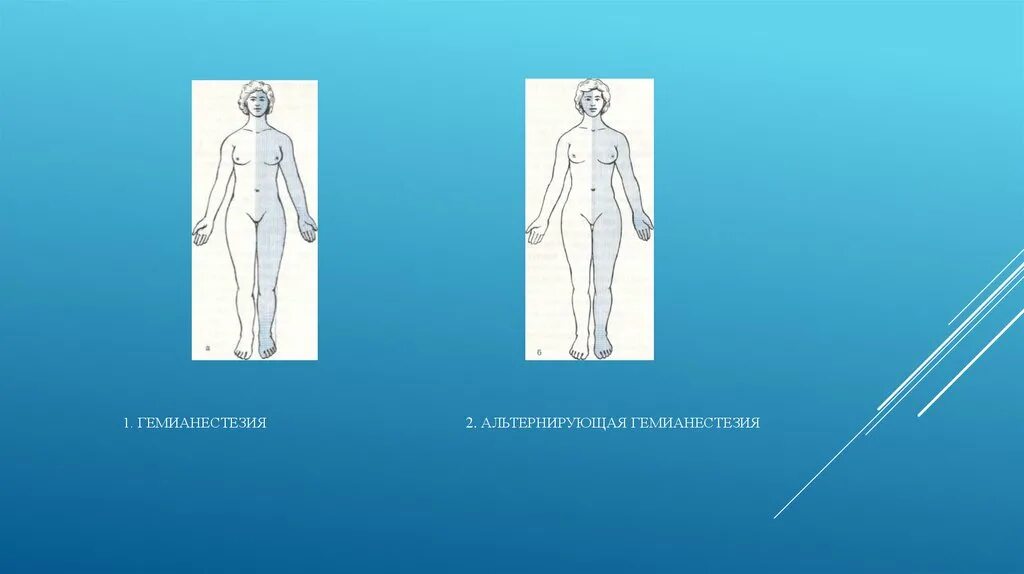 Гемианестезия. Альтернирующая гемианестезия. Правосторонняя гемианестезия. Левосторонняя гемианестезия. Отсутствие чувствительности латынь