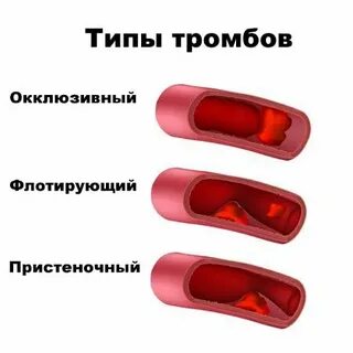Окклюзивный тромбоз