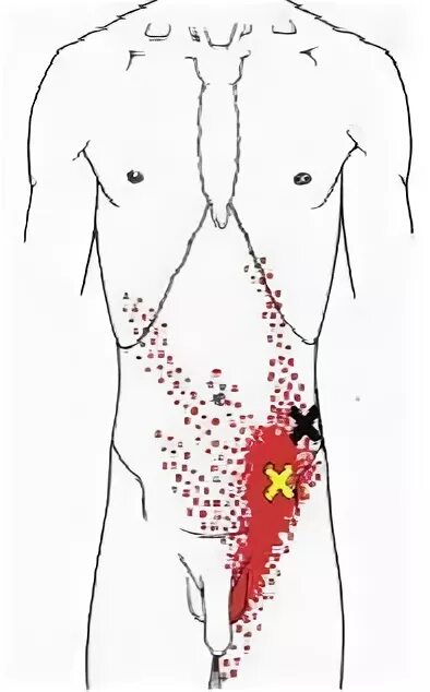 Иррадиация в паховую область. Триггерные точки в области паха. Триггерные точки мышц живота. Триггерные точки на мужчине. Триггерные точки в районе паха.
