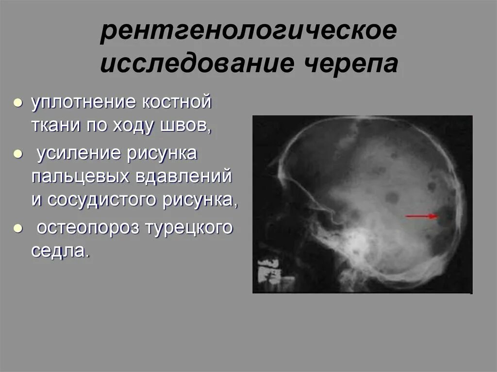 Остеопороз спинки турецкого седла рентген. Остеопороз спинки турецкого седла рентген. Реклингхаузена болезнь остеодистрофия. Рентген признаки внутричерепной гипертензии. Остеопороз рентгенологические признаки.