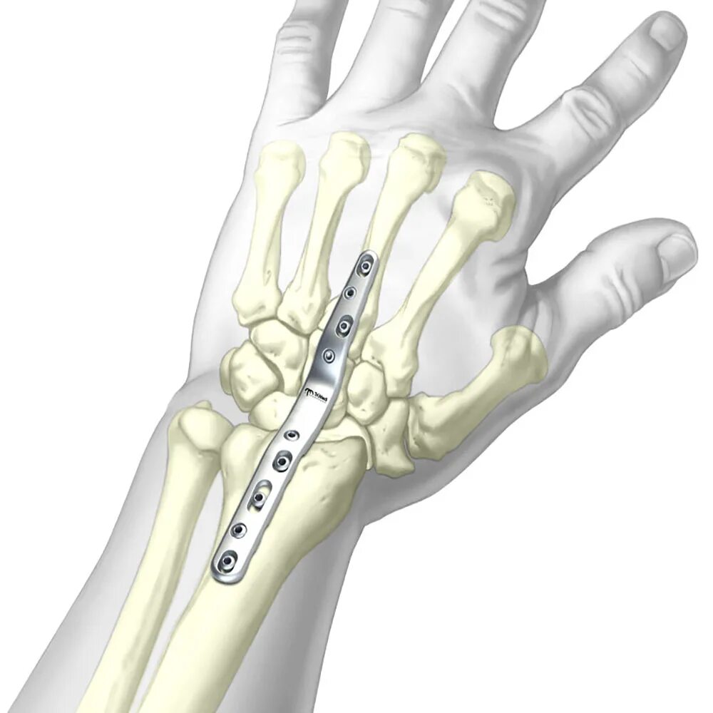 Артродез лучезапястного сустава. Эндопротез лучезапястного сустава. Артродез 1 пястно запястного сустава. Трехсуставной артродез. Пластина в пальце