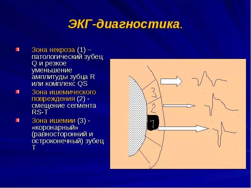 Зона ишемии. Зона повреждения на ЭКГ. Ишемия и некроз на ЭКГ. Зона ишемии на ЭКГ. Зона некроза на ЭКГ.