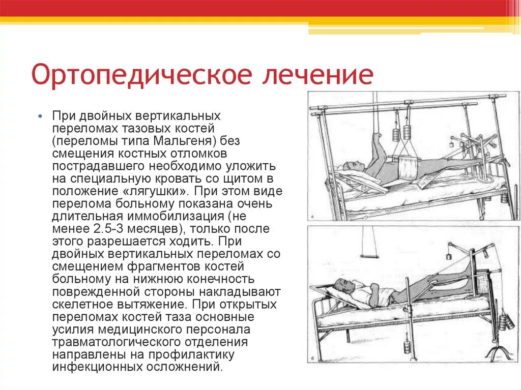 Скелетное вытяжение костей таза. Перелом таза скелетное вытяжение. Ортопедический этап лечения