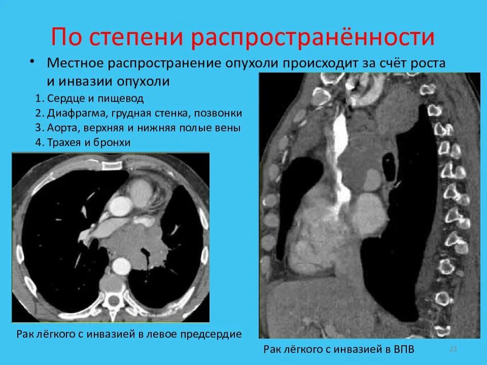 G1 опухоли. Местно распространенные опухоли. Местное влияние опухоли. Опухоли по степени распространенности. Общее воздействие опухоли.