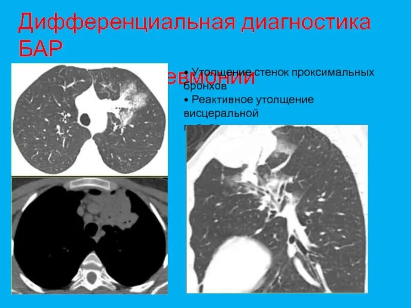 Утолщение бронха. Утолщение стенок бронхов на кт. компьютерная томография бронхов. бронхи на кт. стенки бронхов уплотнены.