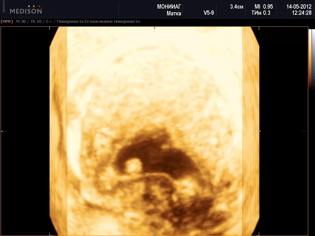 Серозометра в постменопаузе на УЗИ. Эндометрия серозометра в матке. Лечение серозометра матки после 60