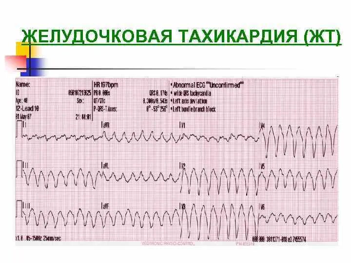 Желудочковая тахикардия на экг. Пароксизмальная желудочковая тахикардия на ЭКГ. ЭКГ при желудочковой тахикардии. Вентрикулярная пароксизмальная тахикардия ЭКГ. ЭКГ при желудочковой пароксизмальной тахикардии.