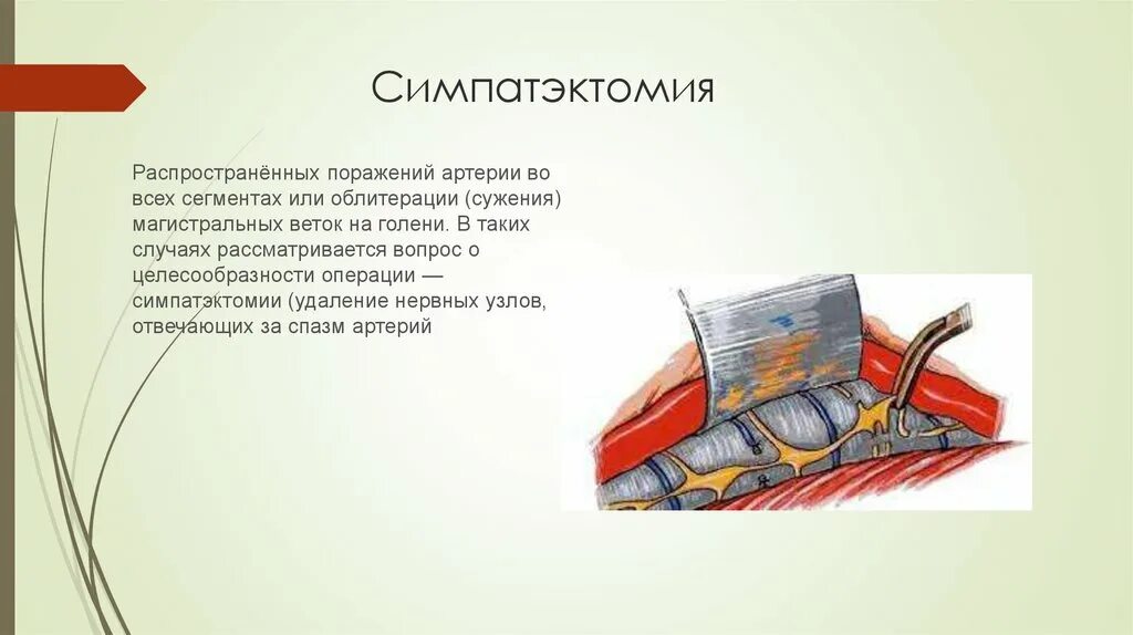 Симпатэктомия цена. Операция симпатэктомия. Поясничная симпатэктомия. Периартериальная симпатэктомия. Эндоскопическая торакальная симпатэктомия.