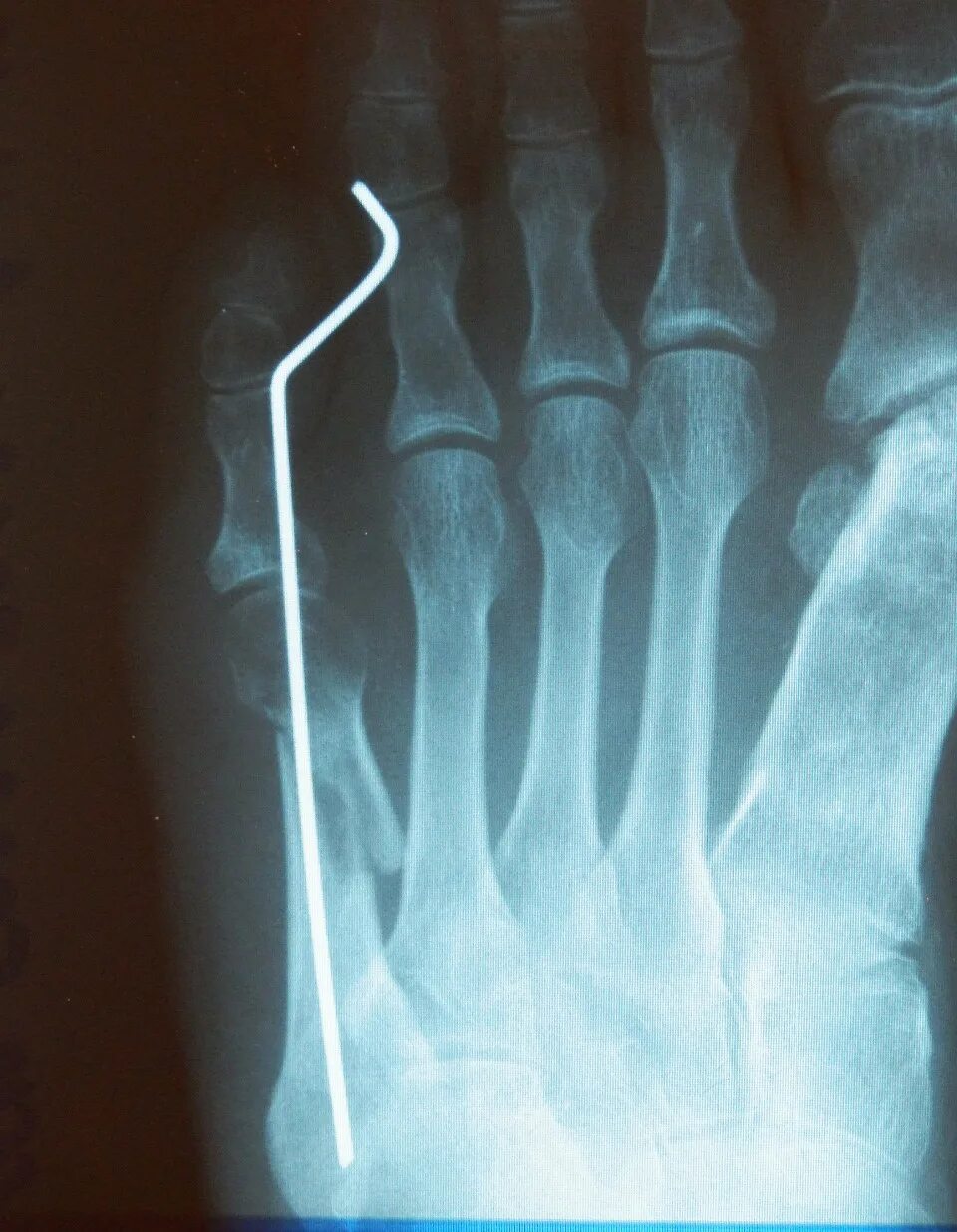 Перелом плюсневой кости 5 пальца. Остеосинтез плюсневой кости стопы. Субкапитальный перелом 5 пястной кости. Перелом 2 пястной кости.