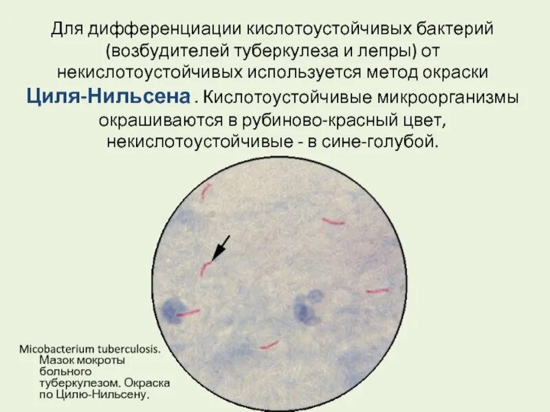 Кислотоустойчивые бактерии по Цилю Нильсену. Окраска кислотоустойчивых бактерий по методу Циля-Нильсена. Возбудитель туберкулеза по Цилю Нильсену. Мазок кислотоустойчивых бактерий по Цилю Нильсену.