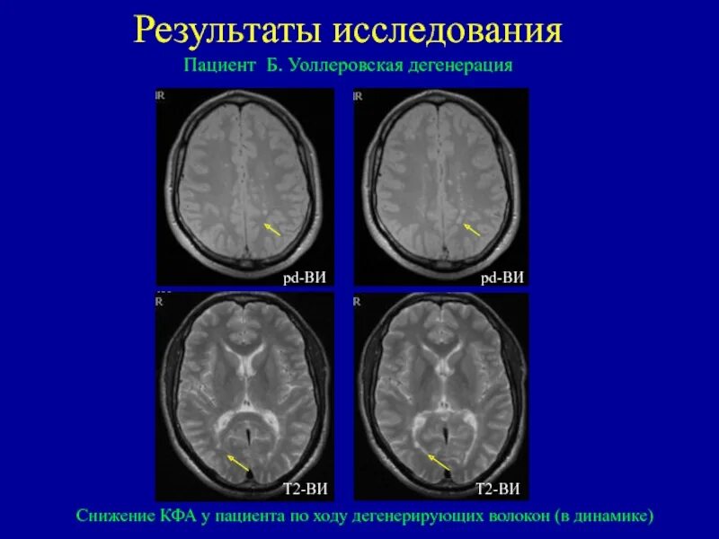 Дегенерация головного. Дегенерация кортикоспинального тракта мрт. Валлеровская дегенерация кортикоспинального тракта. Валлеровская дегенерация мрт. Валлеровская дегенерация кортикоспинального тракта мрт.