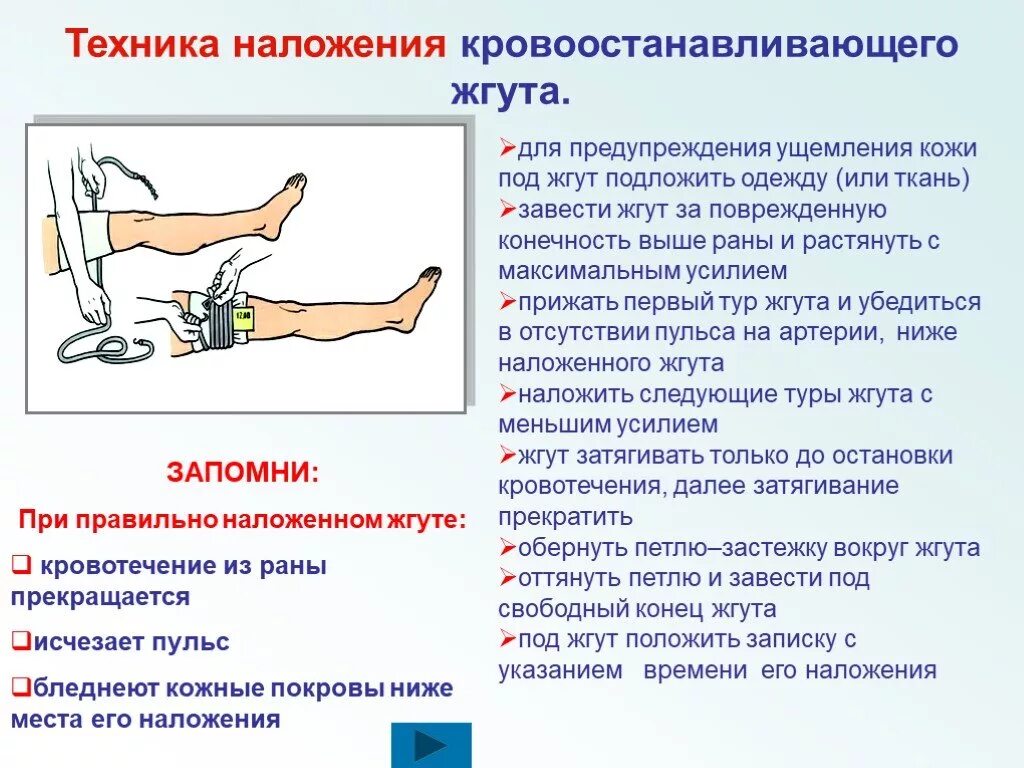 Артериальное кровотечение нижних конечностей. Накладывание жгута при кровотечении. Техника наложения жгута при артериальном кровотечении. Техника наложения жгута при ранении голени.. При правильном наложении жгута для остановки кровотечения:.