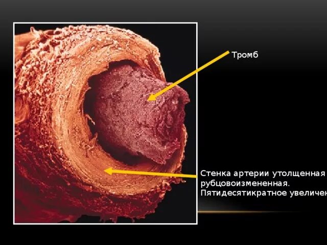 Стена тромба. Утолщение стенок артерий. Утолщенная стенка артерии. Основной тромб