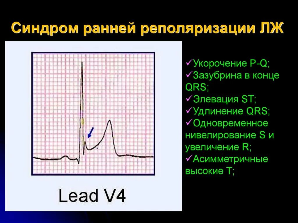 Нарушение процесса реполяризации желудочков в нижней стенке. Феномен ранней реполяризации желудочков. Синдром реполяризации желудочков на ЭКГ что это такое. Ранняя реполяризация желудочков сердца на ЭКГ. ЭКГ феномен ранней реполяризации.