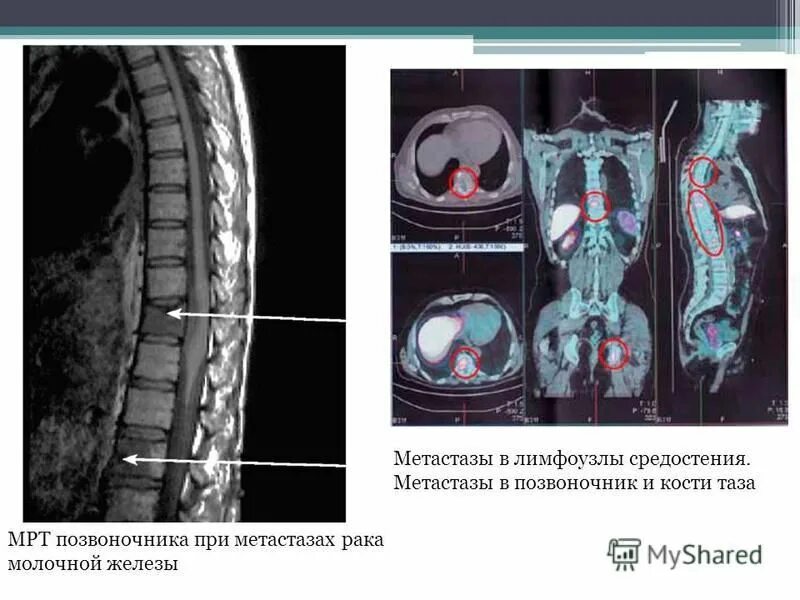 Как долго живут с метастазы в позвоночнике. Метастазы в костях позвоночника на кт. Метастазы в позвоночнике на мрт.