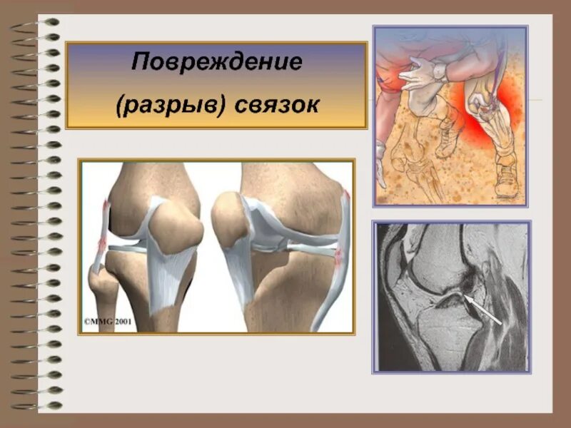 Травматический отрыв связок.