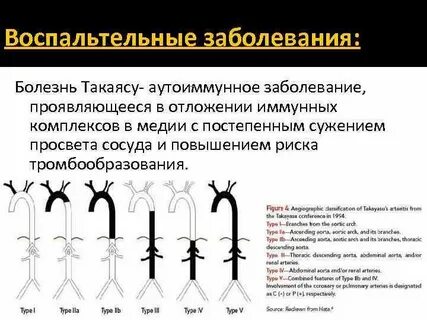 Болезнь такаясу клинические рекомендации