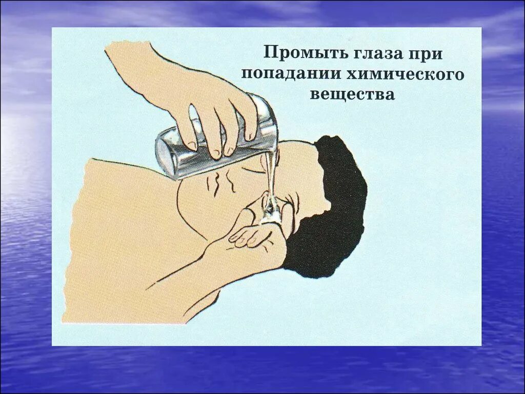 Промывание глаз водой. Оказание помощи при химическом ожоге глаз. Первая помощь при попадании в глаза химического вещества. При попадании в глаза химических веществ.