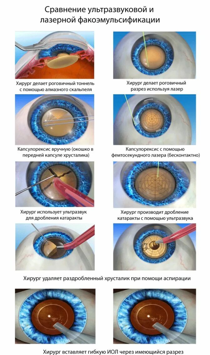 Операция катаракты сколько по времени. Факоэмульсификация катаракты этапы операции. Ультразвуковая факоэмульсификация катаракты этапы. Ультразвуковое хирургия катаракты - факоэмульсификация.