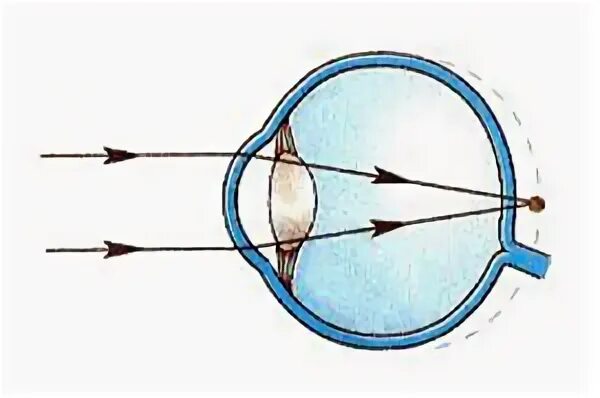Глаз и зрение физика 9. Дефекты зрения дальнозоркость физика. Дефекты зрения очки физика 8 класс. Дальнозоркость с точки зрения физики. Дефекты зрения дальнозоркость ход лучей.