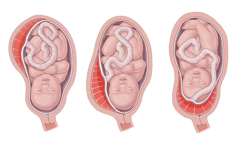 Низко расположена плацента при беременности 16 недель. Низкая плацентация при беременности 20. Низкое расположение плаценты при беременности 27 недель. Низкое расположение плаценты при беременности 20 недель.