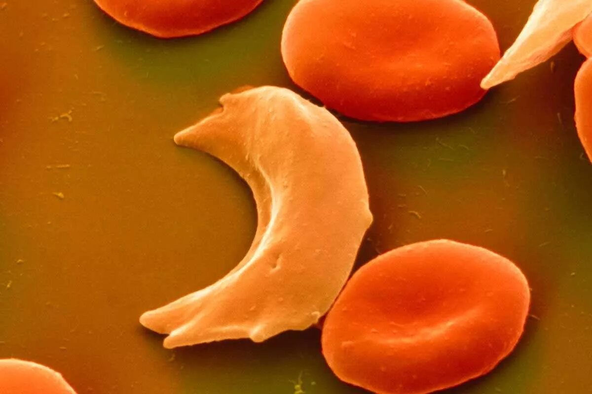 Ген серповидноклеточной анемии. Серповидно клеточная анемия эритроциты. Серповидноклеточная анемия (гемоглобинопатия). Гемоглобинопатии: талассемия, серповидно-клеточная анемия.. Сераповидно клеточная анемия.