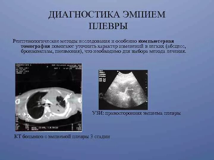 Полость эмпиемы. Полость эмпиемы. Операции при эмпиеме плевры. Плевральная пункция при эмпиеме плевры. Кортикальный отдел легкого.
