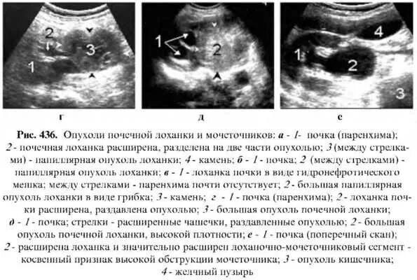 Что значит расширены лоханки почек. Опухоль лоханки почки кт. Опухоль мочеточника УЗИ. Опухоли лоханки и мочеточника.