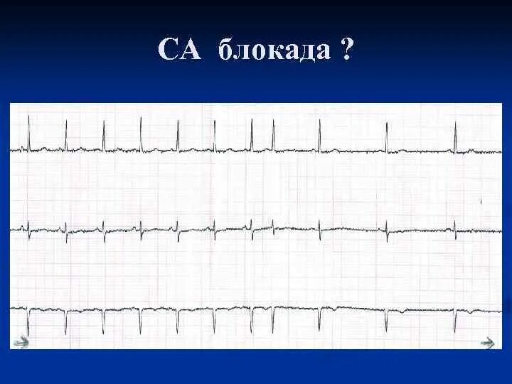 Са блокада 1 степени. Синоатриальная блокада на ЭКГ. Са блокада Мобитц 2. ЭКГ признаки синоатриальной блокады. Синоатриальная блокада 2 степени 1 типа.