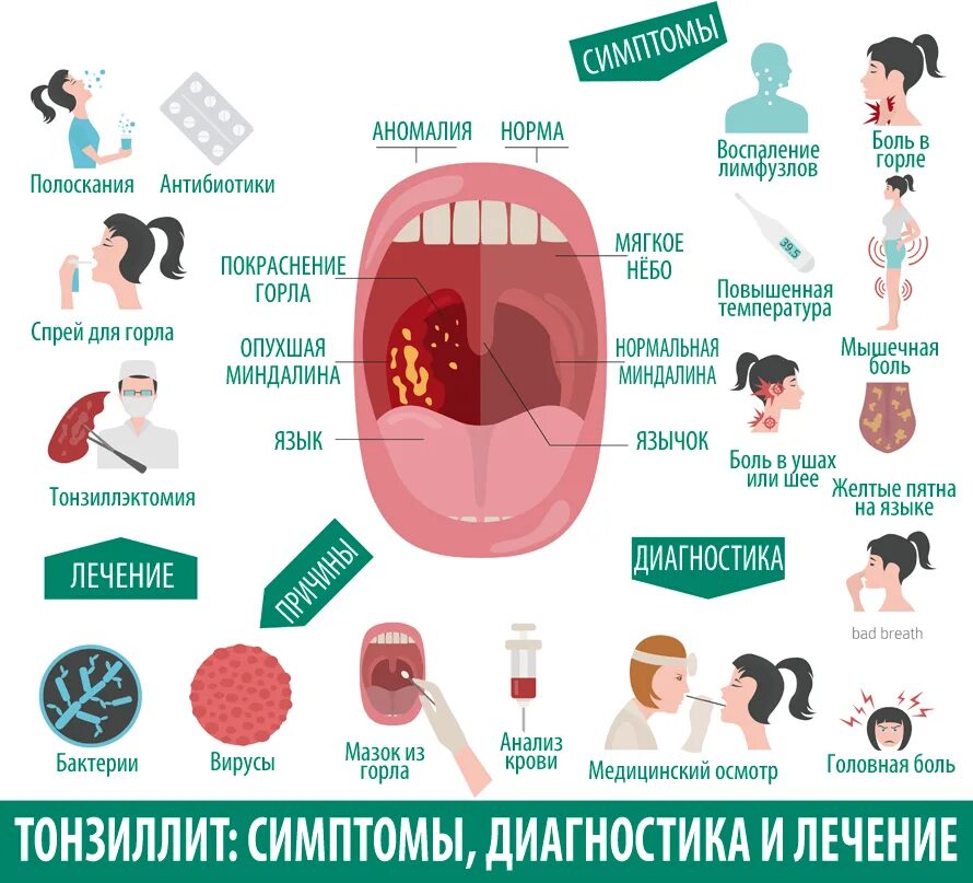 Как лечат ангину у взрослых вылечить быстро