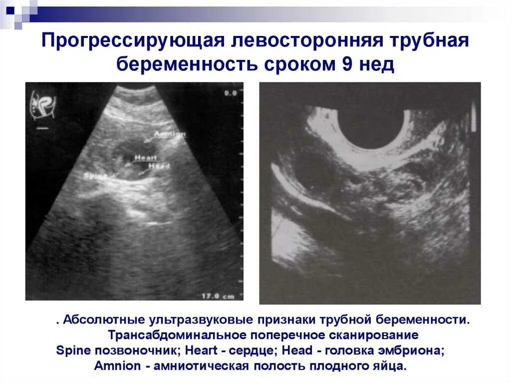 Разрыв маточной трубы на УЗИ. Внематочная Трубная беременность. Осложнения трубной беременности. Что такое маточные Трубная беременность. Внематочная беременность операция сроки