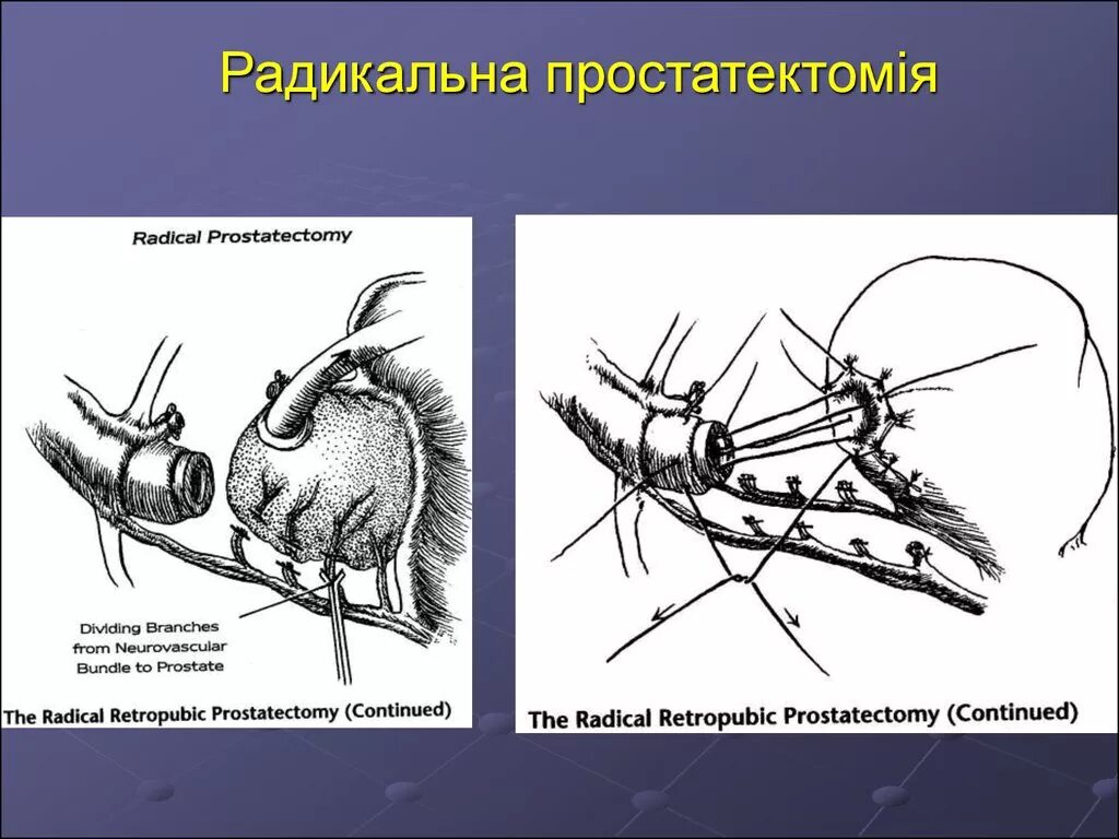 Простатэктомия простаты. Радикальная простатэктомия (позадилонная, лапароскопическая);. Радикальная позадилонная простатэктомия ход операции. Промежностная простатэктомия ход операции. Радикальная простатэктомия схема операции.