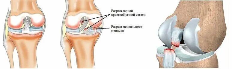 Повреждение крестообразной связки коленного сустава. Повреждения передней крестообразной связки (ПКС). Разрыв ПКС коленного сустава. Разрыв крестообразной связки сустава колена.