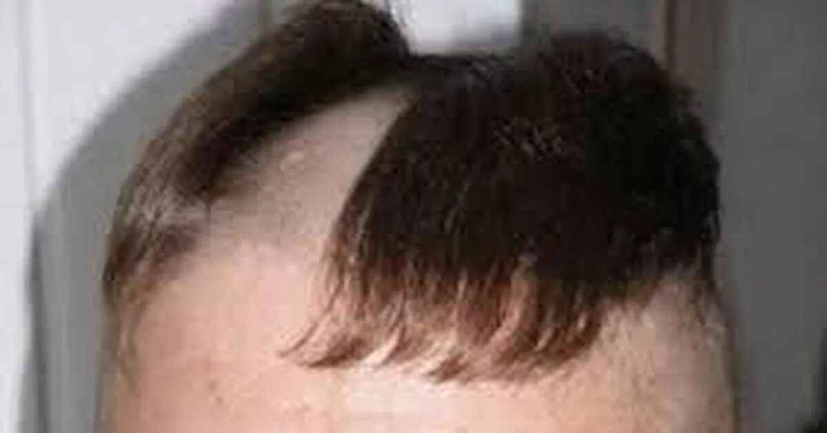 Прически с лысиной на голове. Мужская причёска с лысиной посередине. Мужские стрижки с лысиной на макушке. Прическа посередине лысина по бокам волосы.