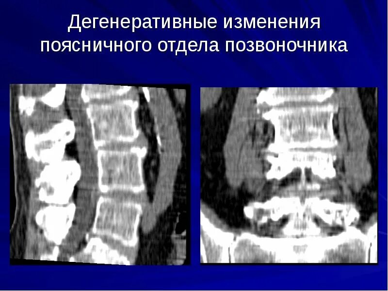 Дегенеративные изменения пояснично-крестцового отдела позвоночника. Дегенеративно-дистрофические изменения позвоночника на кт. Дегенеративные изменения позвоночника поясничного. Дегенеративные изменения позвонков.