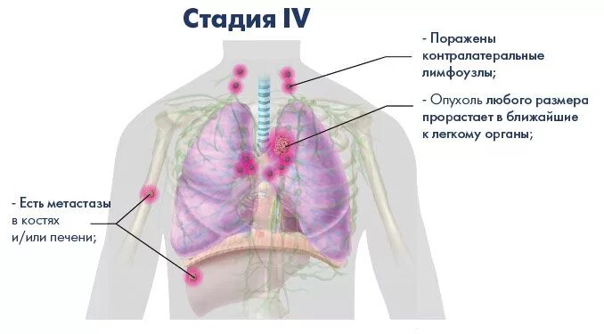 Легкие онкология 4 стадии. 4 Степень метастазы легких. Онкология легких стадии. Раковая опухоль в легком. 4 стадия злокачественная