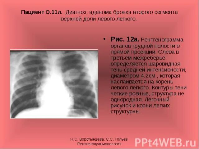 Тень в верхней доле. Тень средней интенсивности на рентгенограмме. Интенсивность на рентгенограмме. Интенсивность тени на рентгенограмме. Очаговую тень в первом межреберье.