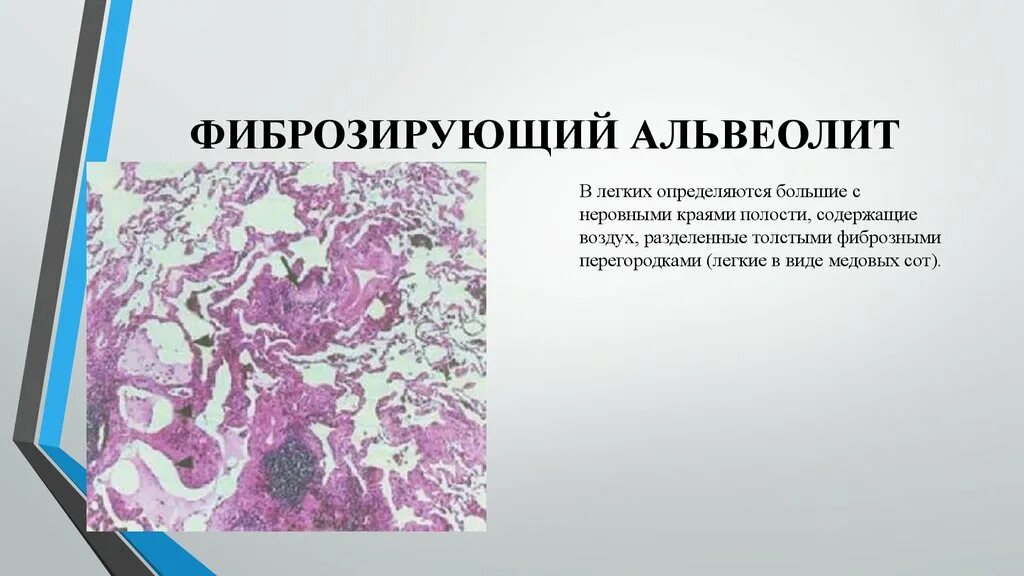 Идиопатический фиброзирующий альвеолит патологическая анатомия. Альвеолит легких микропрепарат. Фиброзирующий альвеолит гистология. Идиопатический легочный фиброз гистология.