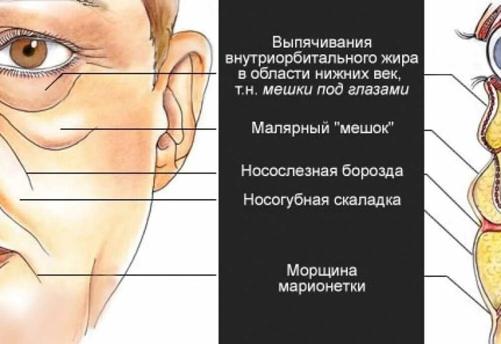 Почему образуются мешки. Малярные мешки. Малярные мешки под глазами. Мешки на скулах под глазами. Малярный жировой мешок.